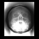 Osteoma of frontal sinus: X-ray - Plain radiograph